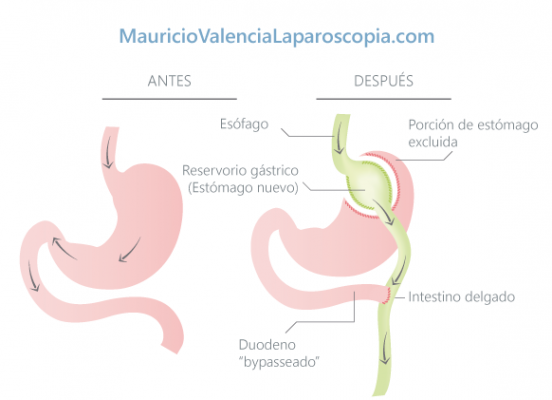 Bypass Gástrico