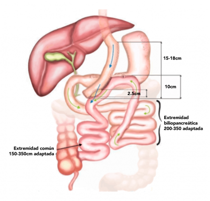 Bypass gástrico de una anastomosis (BAGUA)